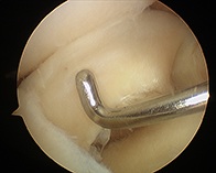 ACL Hamstring