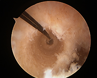 ACL Femoral Tunnel Drill