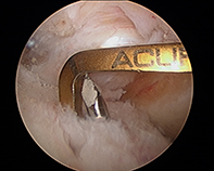 ACL Tibial JIG