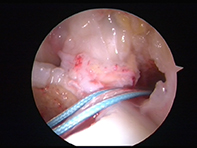 ACL Tunnels Passing Graft