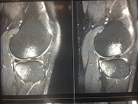 Bony Bruising Pattern ACL Tear