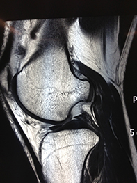 Chondral Defect