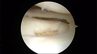 Chondral Tibial Flap Microfracture