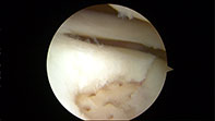 Chondral Tibial Flap Microfracture