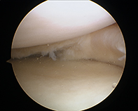 Folded Medial Meniscal Tear