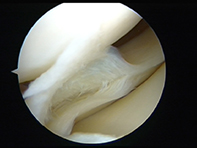 Horizintal Cleavage Tear Meniscus