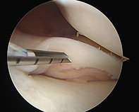 Lateral Meniscal Repair New