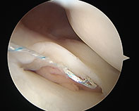 Lateral Meniscal Repair New