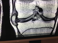 MRI Lateral Parameniscal Cyst