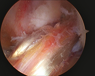 New ACL Graft