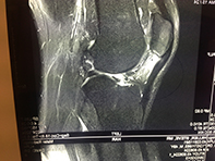 Patellar Tendinopathy