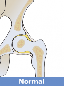 Periacetabular  Osteotomy